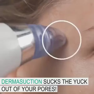 🖤 ​​جهاز شفط لإزالة الرؤوس السوداء – منظف عميق للمسام لبشرة صافية