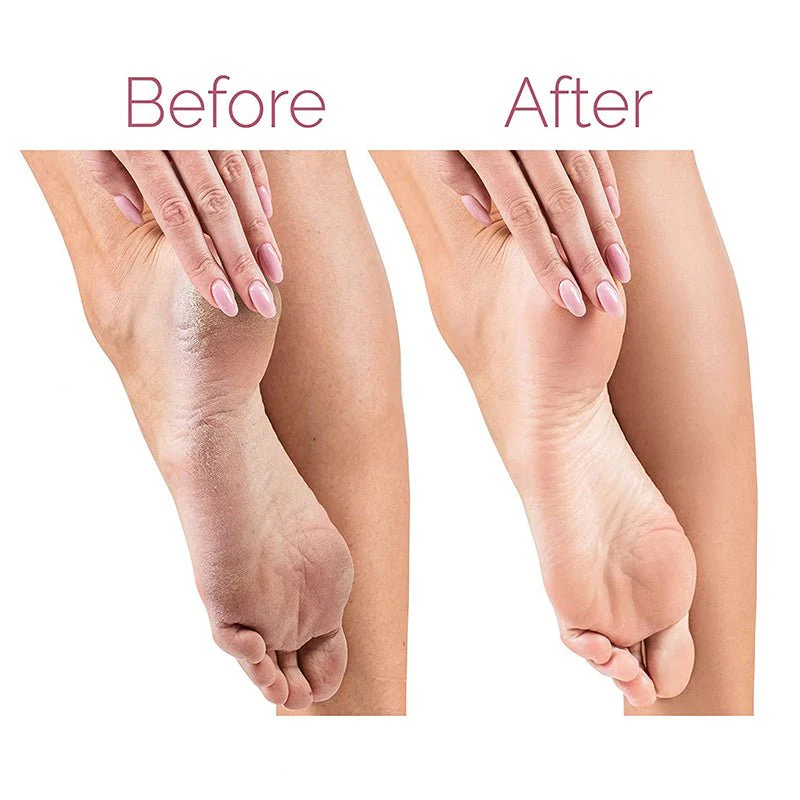 Electric Callus Remover - Rechargeable Foot File for Smooth Heels