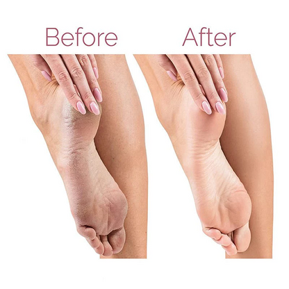 Electric Callus Remover - Rechargeable Foot File for Smooth Heels